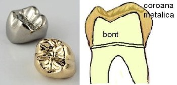 Coroana totala metalica