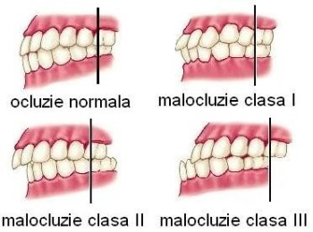 Malocluzia dentara