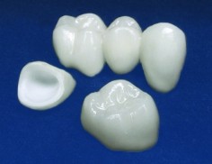 Coroana ceramica pe suport de zirconiu