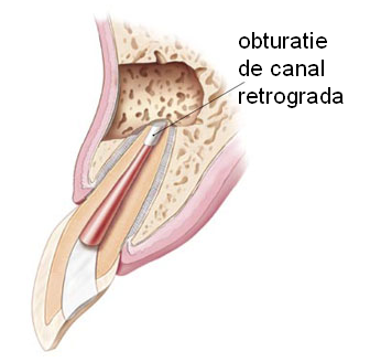 Obturatie de canal retrograda