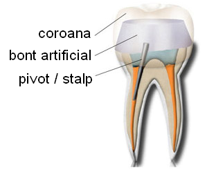 Reconstituire corono-radiculara