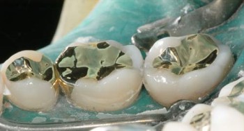 Incrustatii metalice