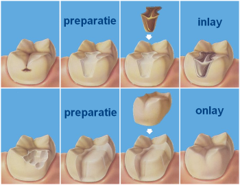 Incrustatii fizionomice