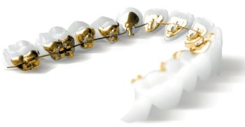 Aparat ortodontic lingual