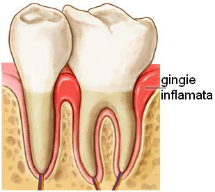 Gingivita