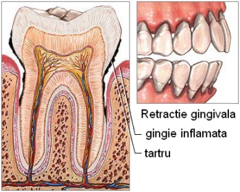 Periodontita