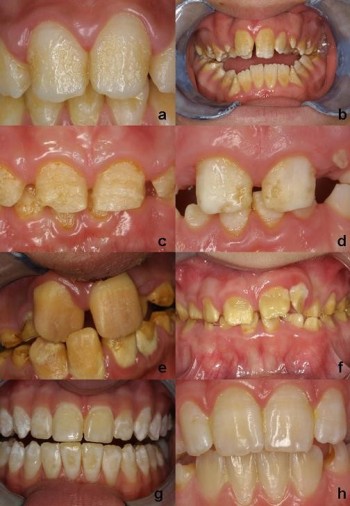 Amelogenesis imperfecta